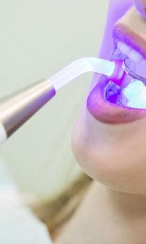 Distribuidor de lâmpada UV dentista
